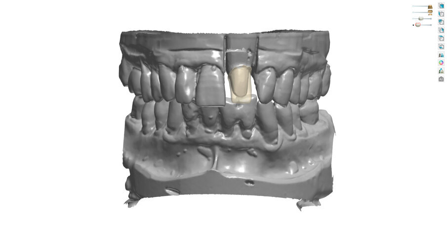 Fig. 2: After matching the wax-up with the master model, the functional cap could be designed.