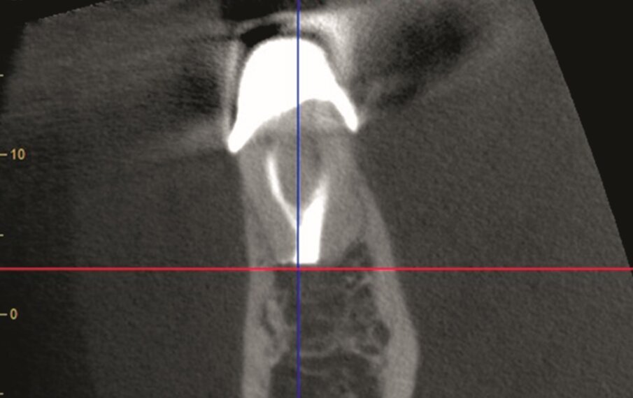 … coronal (m) …