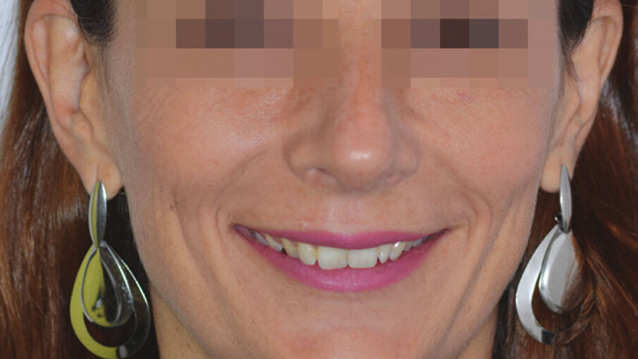 Figg. 10a, 10b_Foto extraorali ed intraorali di inizio trattamento. Il sorriso iniziale della paziente non permetteva una eccessiva intrusione degli incisivi superiori ma, nonostante questo, risulta migliorato il display dentale e l’ampiezza del sorriso.