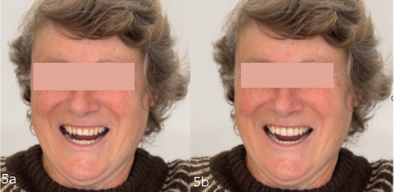 Figs. 5a & b: Still pre- (a) and posttreatment photographs (b) taken from the ClinCheck video—video integration into both orthodontic and restorative software allows for greater critical analysis and planning, including the full range of dynamic lip movements and gingival display characteristics to maximise position planning and aesthetic and functional outcomes.