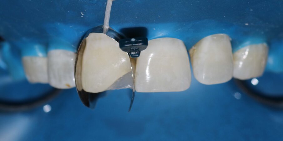 Fig 9: Unica Anterior matrix with wedge after building the palatal shell 