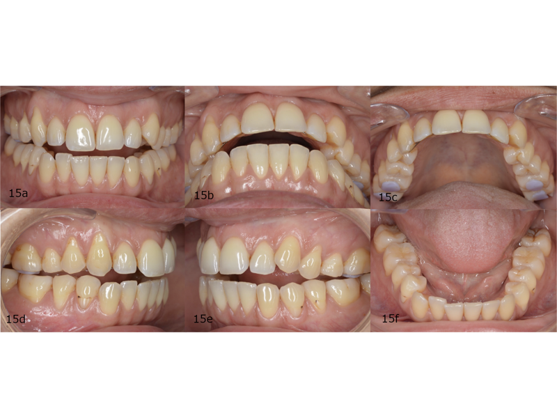Figs. 15a–f: Occlusal stops placed in the mouth.