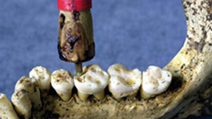 Historia de la odontología. Capítulo I: Primeras técnicas odontológicas