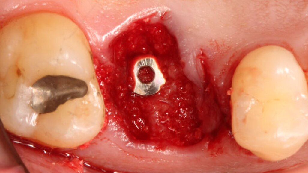 Digital peri-implant tissue healing