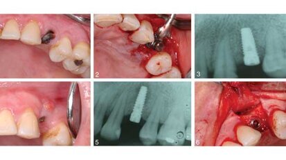 Guided bone regeneration treats implant lesions