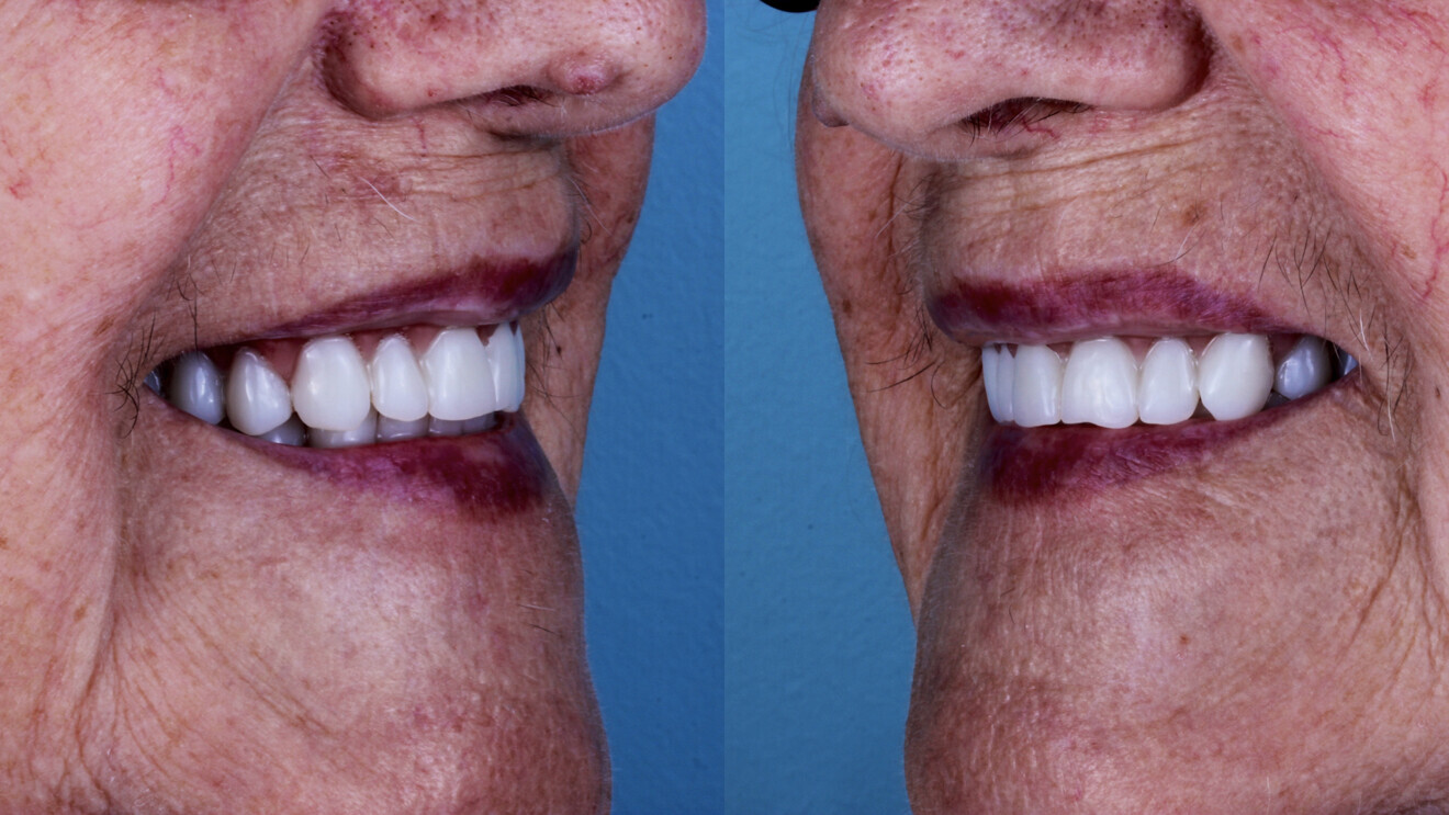 Fig. 13 : Vues latérales avec la prothèse d’usage imprimée en 3D.