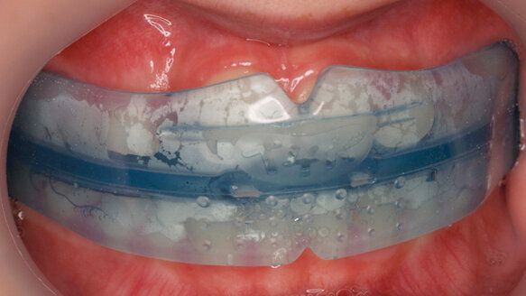 Tooth positioning appliances: An orthodontist’s experience