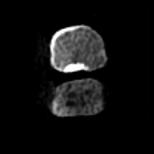 Fig. 2 : Coupe transversale horizontale obtenue au moyen du scanner i-CAT (DEXIS) montrant une calcification totale de l’orifice du canal radiculaire au niveau de la jonction amélo-cémentaire, par comparaison avec la première molaire.