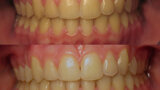 Figura 10. Caso clínico antes y después de un blanqueamiento dental con cubetas listas para usar.