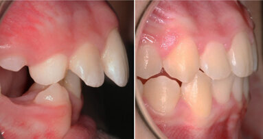 Pre-orthodontic options for 21st-century parents