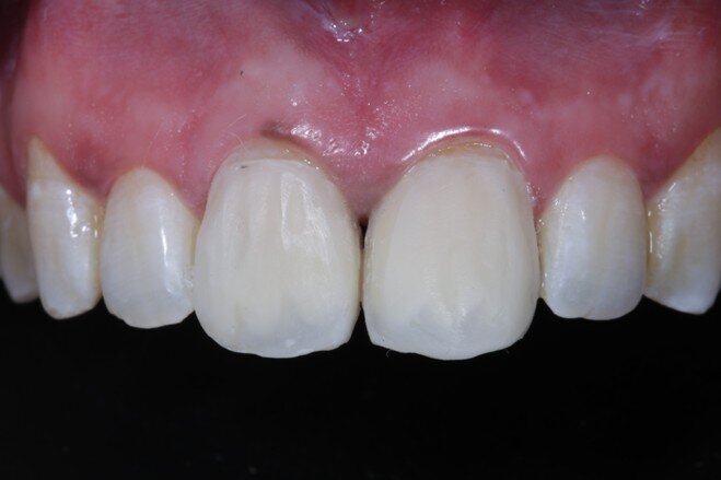 Fig 16 Pre polishing