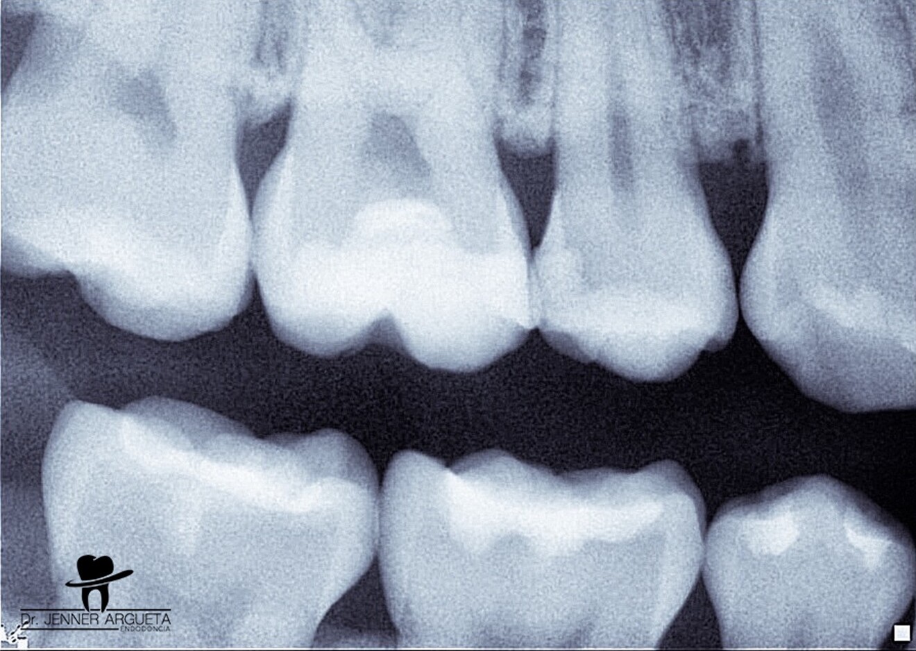 Fig. 9: Final bitewing radiograph of the vital pulp therapy procedure showing the different layers of materials used and the correct marginal adaptation.