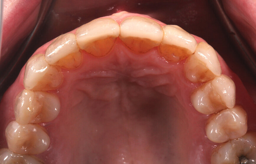 Fig. 23: Bonded veneers, occlusal view.