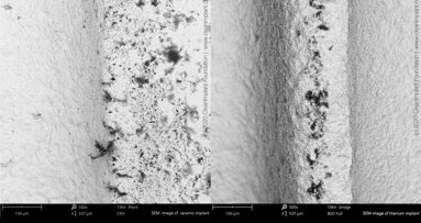 Sterile and yet dirty?Quality deficiencies of sterile-packaged ceramic and titanium implants