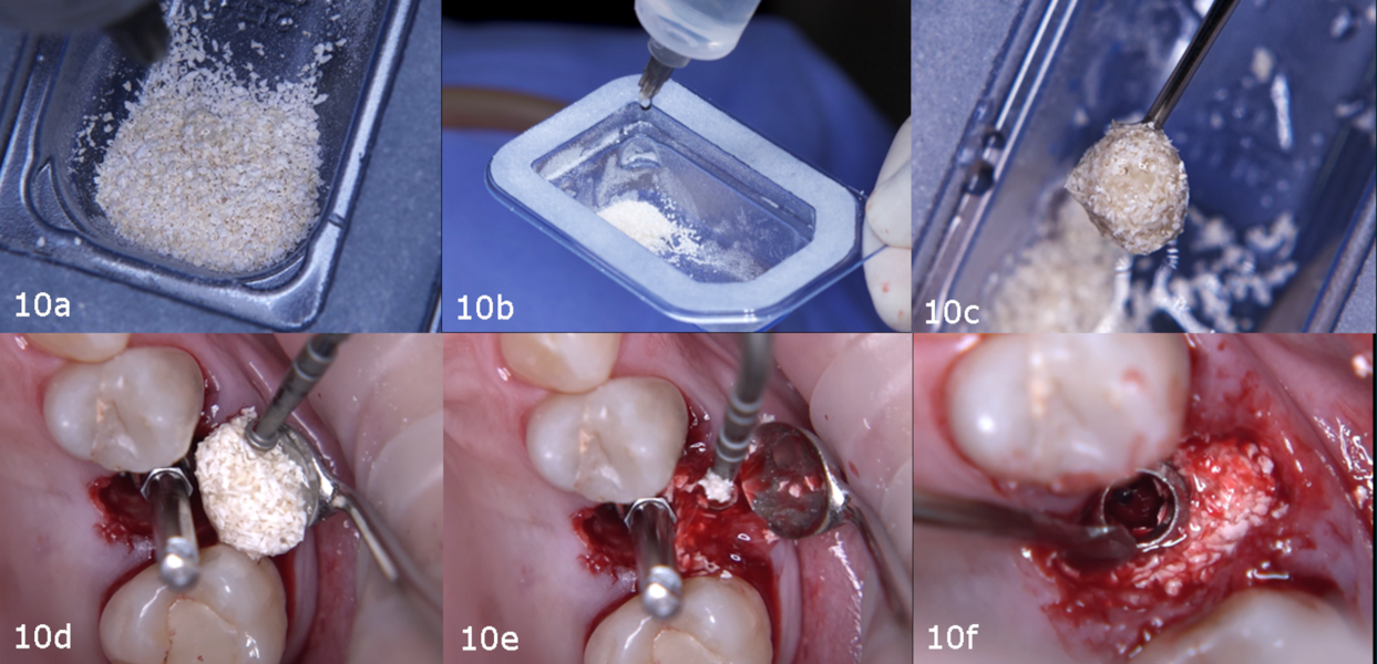 Figs. 10a–f: Preparation of cerabone plus (botiss biomaterials) for gap filling.