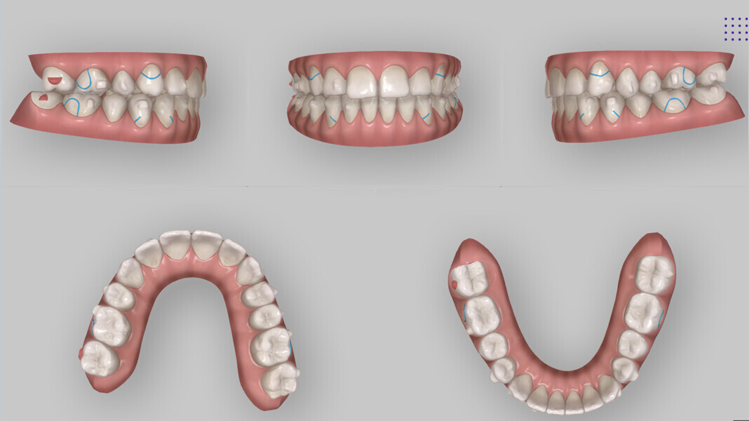 Fig. 11: New ClinCheck treatment plan for additional aligners—ten refinement aligner sets with button cut-outs to improve occlusion and canine guidance.