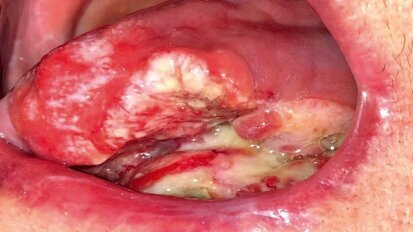 El dentista en el tratamiento del cáncer de cabeza y cuello