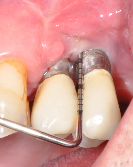 Fig.20: Case 2. 12 months healing. PPD reduction and BOP absence are noticeable.