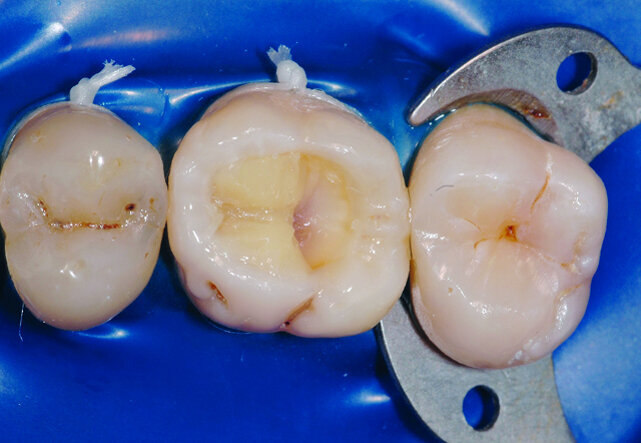 Fig. 25: Vue occlusale après apport du deuxième incrément de masse dentine. Ce deuxième apport est appliqué
comme précédemment en position oblique. 