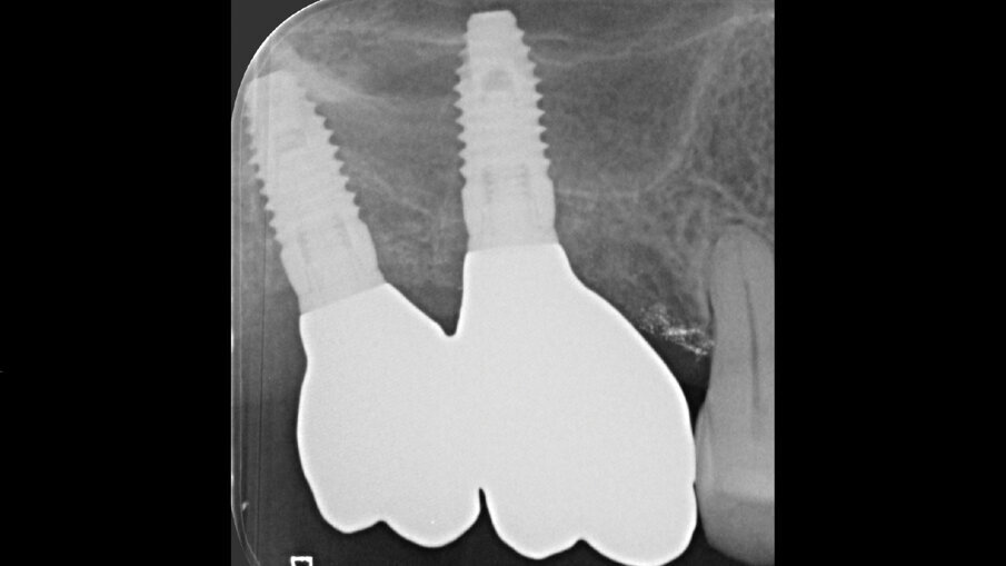 Fig. 10 - In alto, a 9 mesi dall’inserimento implantare immediato, la consegna delle protesi finali in zirconia. In basso, radiografia endorale che mostra il mantenimento volumetrico del volume osseo.