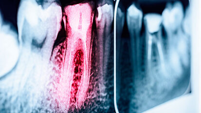 Endodonzia al IX Congresso AIO di Chia: Un microcosmo che mantiene il suo fascino