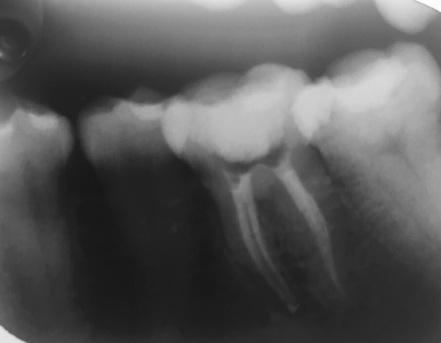 Post obturation radiograph