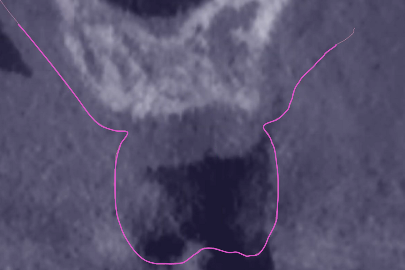Fig. 5a:  Implementation of the enhanced merging methodology at prosthesis delivery. Superimposition of the intra-oral scan taken at prosthesis delivery (purple line) on the pre-op CBCT scan (the right side is the buccal side).