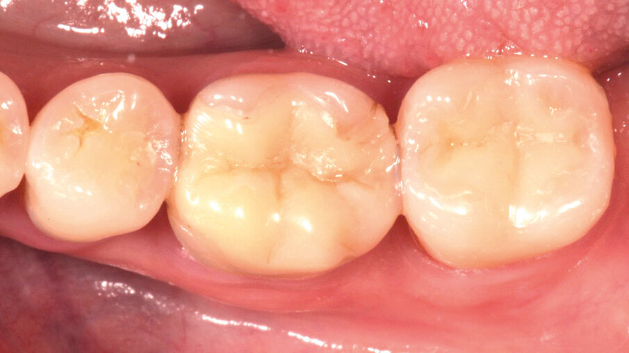 Fig. 2: Due to the size of the restoration, the amount of remaining tooth structure might not be sufficient to ensure the required stability for a direct composite restoration.