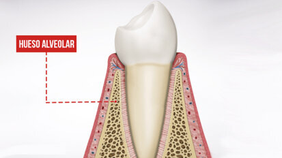 Biointegración cervical periimplantaria. Bundle Bone