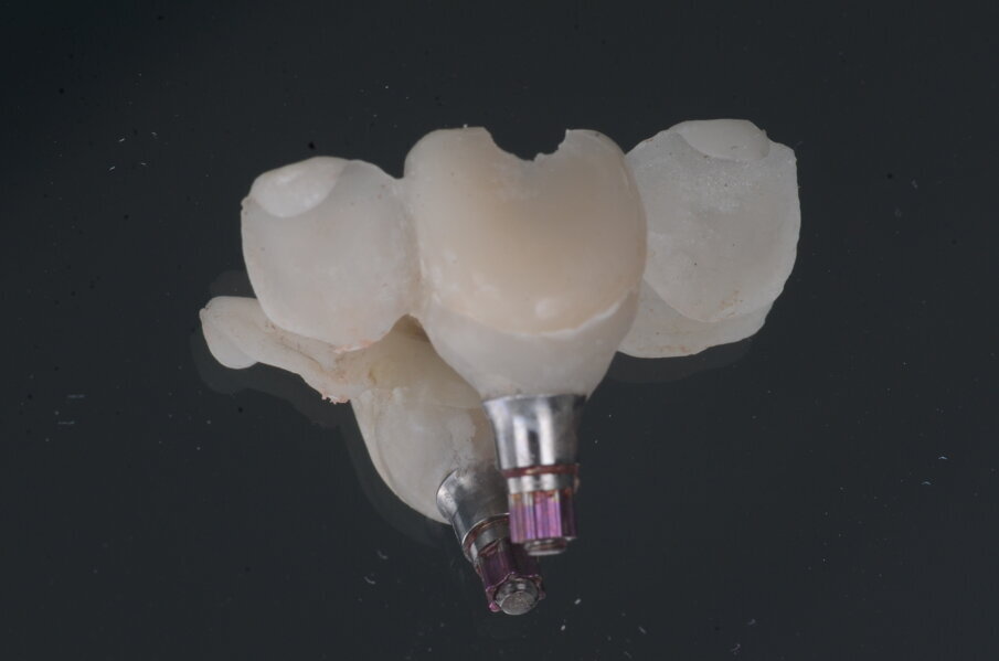 Fig. 26_Guscio provvisorio del dente dopo la presa dell'impronta e la creazione del profilo di emergenza.