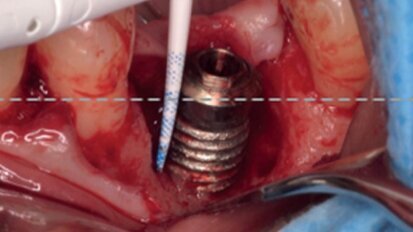 Surgical treatment of circumferential and semicircumferential defects due to periimplantitis: A prospective case series cohort study