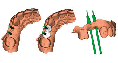 Full digital workflow nella pratica quotidiana in implantologia Studio clinico prospettico