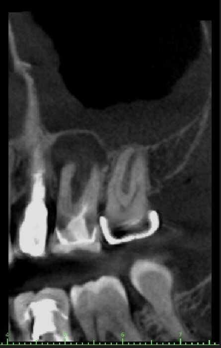 Fig. 3 - Esame CBCT preoperatorio (sezione sagittale).