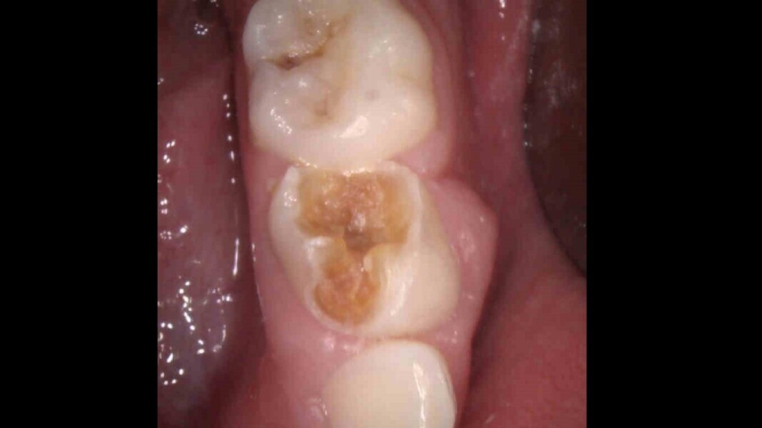 Fig. 5: Initial condition. Severe decay and buccal abscess.