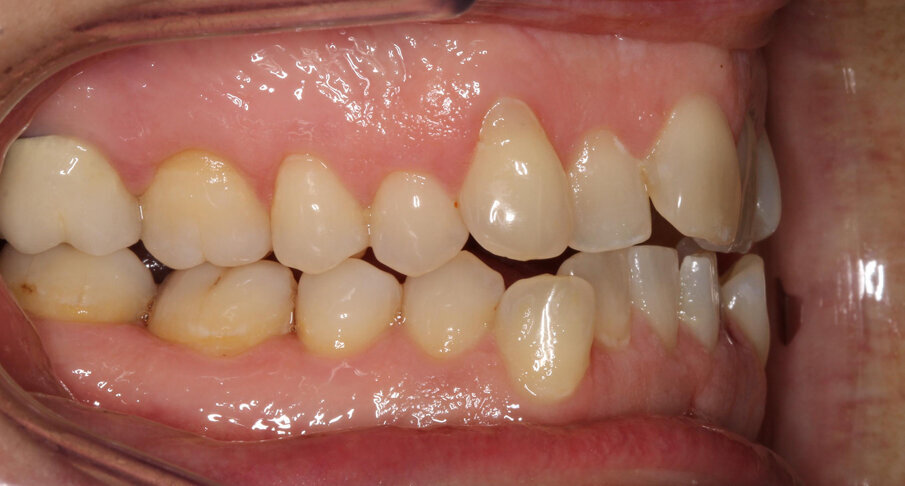Pre-treatment