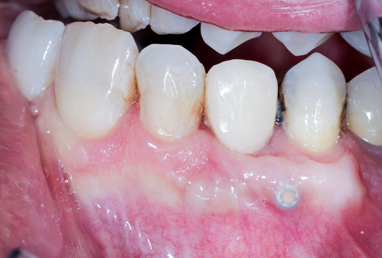 Fig. 19: The osteosynthesis screw was visible under the gingiva and was thus removed after six months.