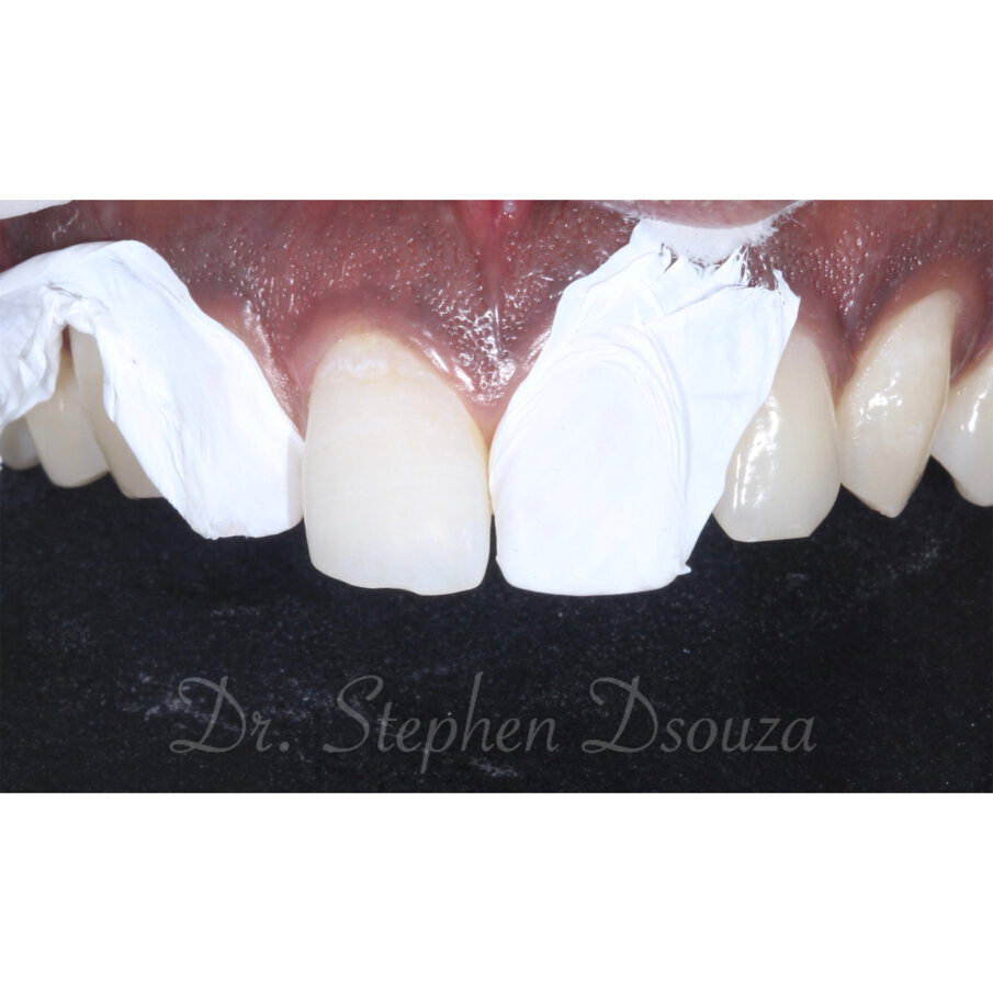 Fig. 5 PTFE tape to cover the adjacent teeth