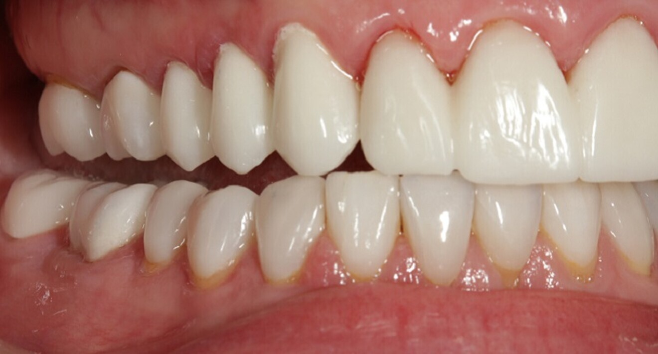 Fig. 16: Anterior guidance and canine disclusion were shown in the right working movement, displaying separation of all posterior teeth.