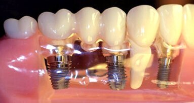 Fila de implantes