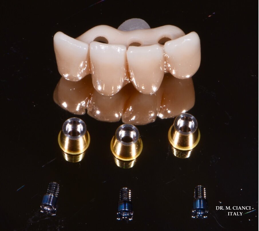 Fig. 12 - Protesi provvisoria 3D in PMMA avvitata.