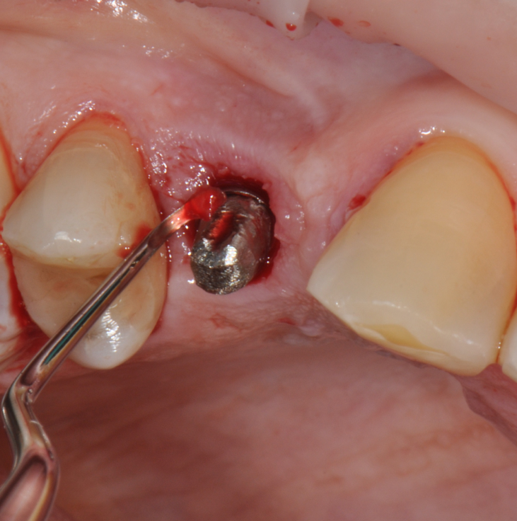 Fig.9: Internal pocket line curettage.