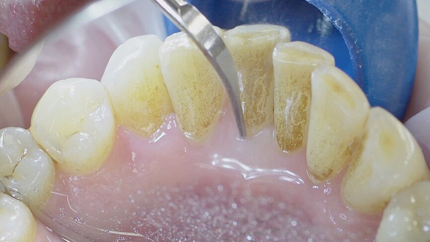 Fig. 1: Calculus removal using an ultrasound (W&H Tigon (+) with a 3U tip) is a key part of professional tooth cleaning. (Photograph: W&H)