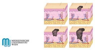 Hautkrebs: Protein hemmt Bildung von Metastasen