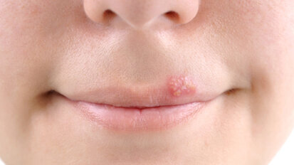 Weltneuheit kann Lippenherpes-Ausbrüche verhindern