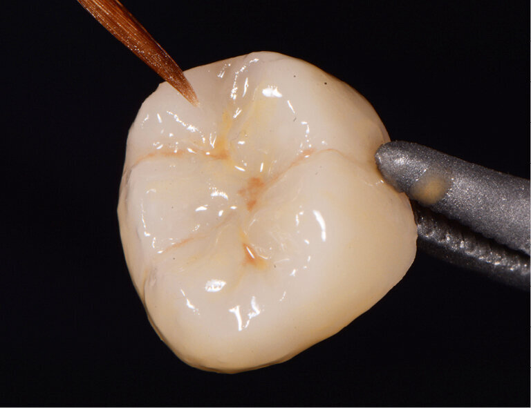 Fig. 4: Characterized and glazed crown
