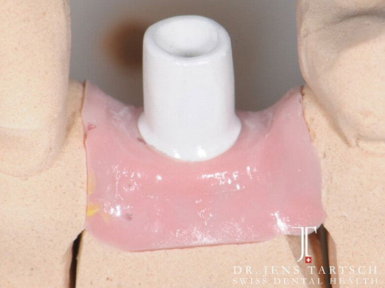 Fig. 10: Individualized abutment on master cast. (Photo: Jens Tartsch, DMD)