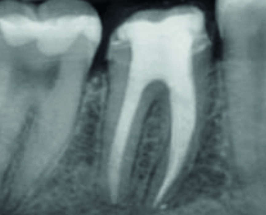 Fig. 8: Control radiograph after six months