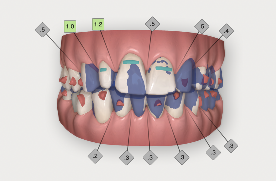 Fig. 5: ClinCheck with superimposition of the initial situation (in blue).