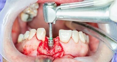 Los implantes de Straumann destacan en estudio