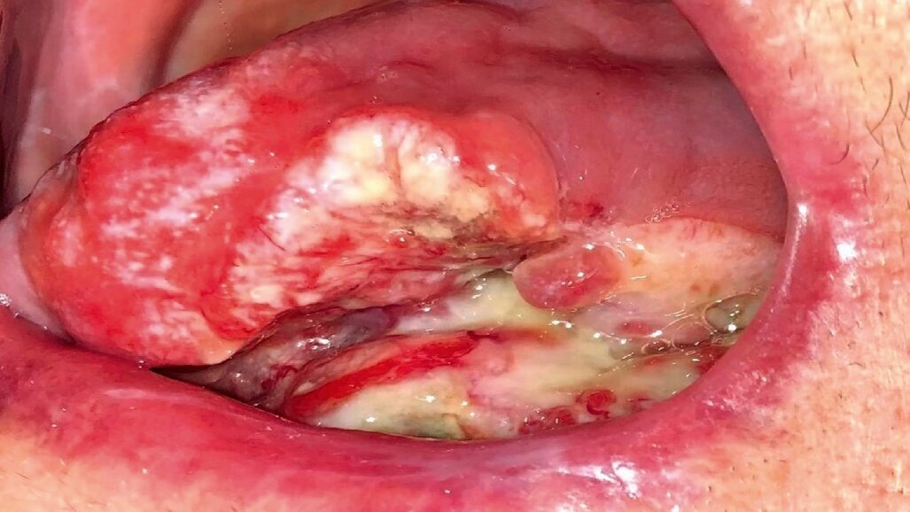 El dentista en el tratamiento del cáncer de cabeza y cuello